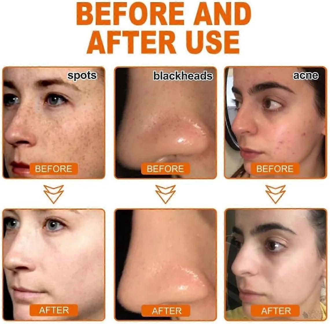 Seurico™ Whitening and Freckle - Removing Mask