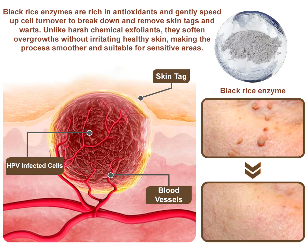 ✅ Zvoevo® Rice Bran Extract Cream 👩‍⚕️ TGA-Certified (For removing warts and skin growths, eliminating skin hyperplasia and keratin buildup, treating skin cancer, age spots, and hyperpigmentation)