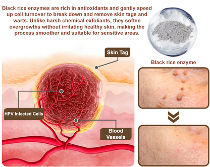 ✅ Zvoevo® Rice Bran Extract Cream 👩‍⚕️ TGA-Certified (For removing warts and skin growths, eliminating skin hyperplasia and keratin buildup, treating skin cancer, age spots, and hyperpigmentation)