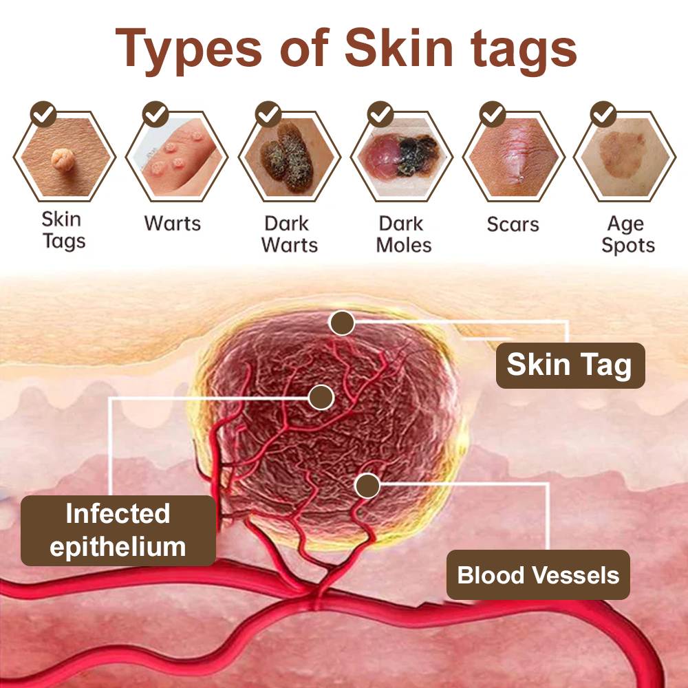✅ Zvoevo® Rice Bran Extract Cream 👩‍⚕️ TGA-Certified (For removing warts and skin growths, eliminating skin hyperplasia and keratin buildup, treating skin cancer, age spots, and hyperpigmentation)