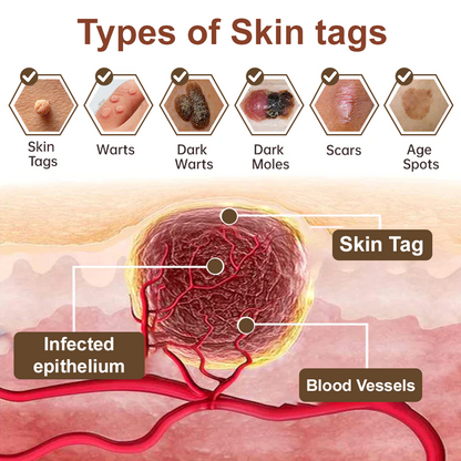 ✅ Zvoevo® Rice Bran Extract Cream 👩‍⚕️ TGA-Certified (For removing warts and skin growths, eliminating skin hyperplasia and keratin buildup, treating skin cancer, age spots, and hyperpigmentation)