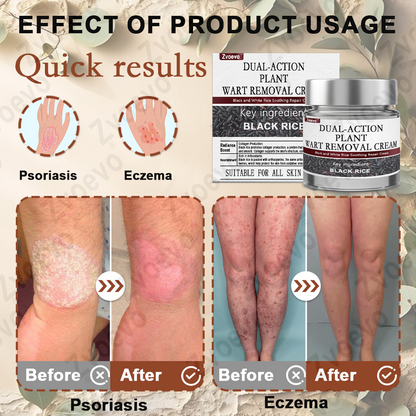 ✅ Zvoevo® Rice Bran Extract Cream 👩‍⚕️ TGA-Certified (For removing warts and skin growths, eliminating skin hyperplasia and keratin buildup, treating skin cancer, age spots, and hyperpigmentation)